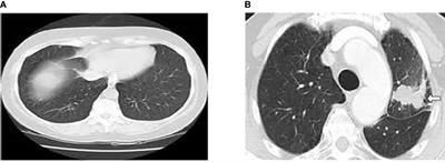 Early Prediction of Lung Cancers Using Deep Saliency Capsule and Pre-Trained Deep Learning Frameworks